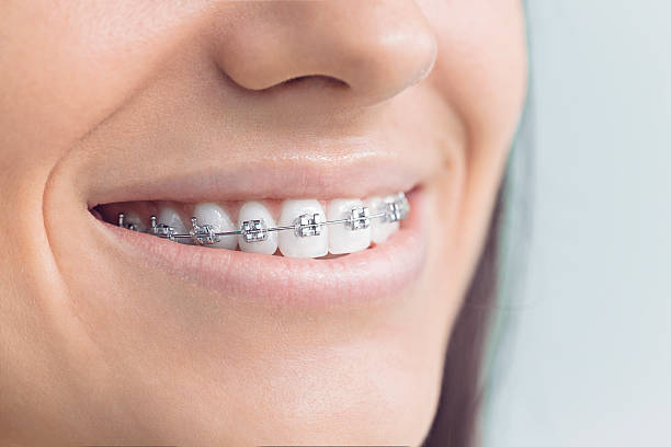Best Veneers and Lumineers  in Nelsonville, OH